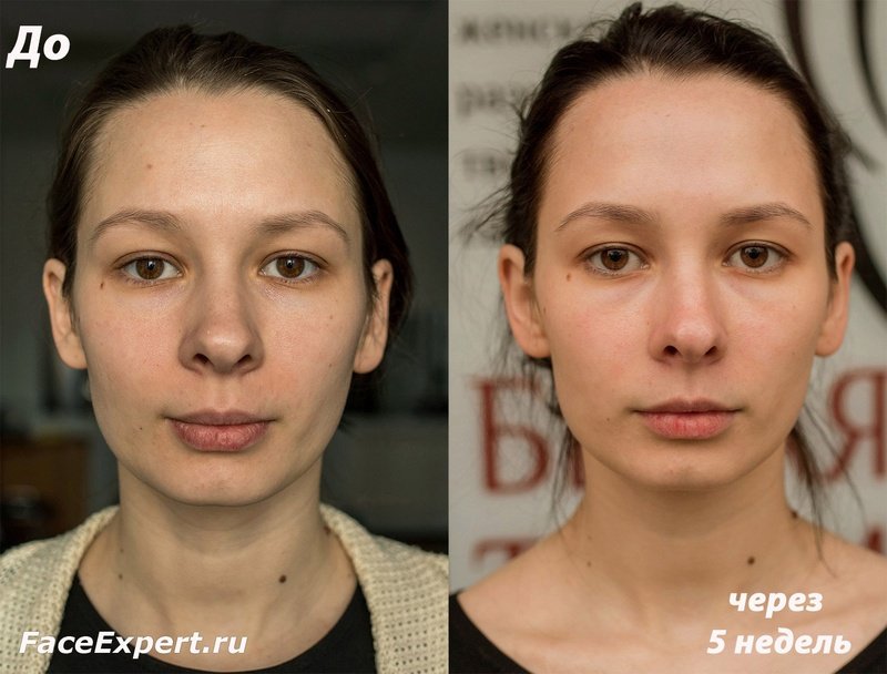 Результат Веры Тимофеевой после 5-недельного коучинга Юлии Ковалёвой по гимнастике для лица